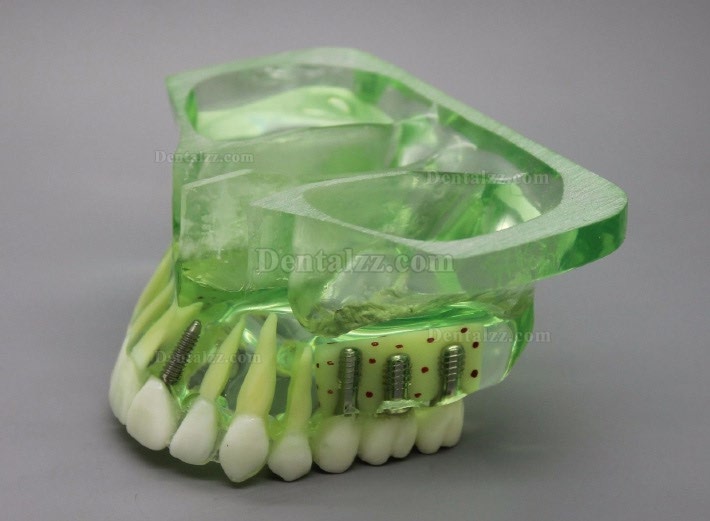 歯科モデル＃2015 01 - 上顎義歯インプラントモデル 副鼻腔付き